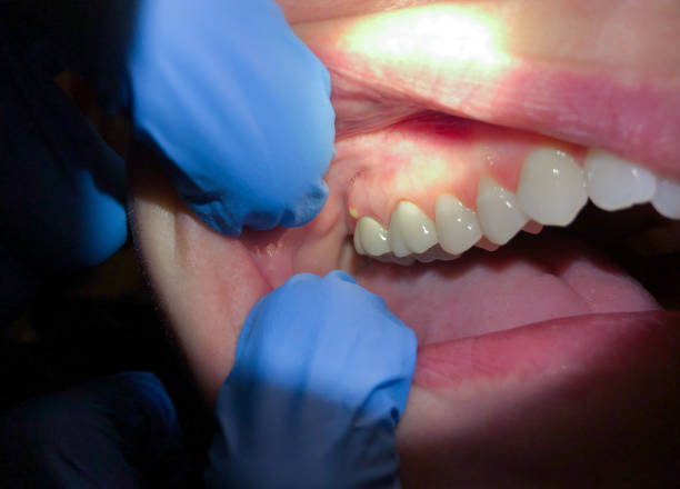 Best Emergency Wisdom Teeth Removal in Booneville, MS